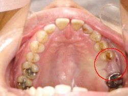 岡山、倉敷市のインプラント歯科、岡山インプラント支援センターのインプラント症例