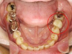 岡山、倉敷市のインプラント歯科、岡山インプラント支援センターのインプラント症例